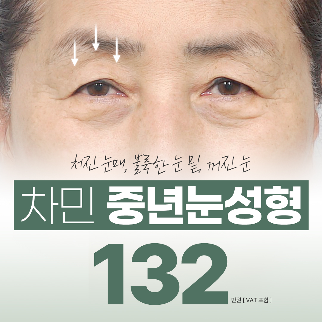 차민 중년눈성형 이벤트 썸네일 이미지
