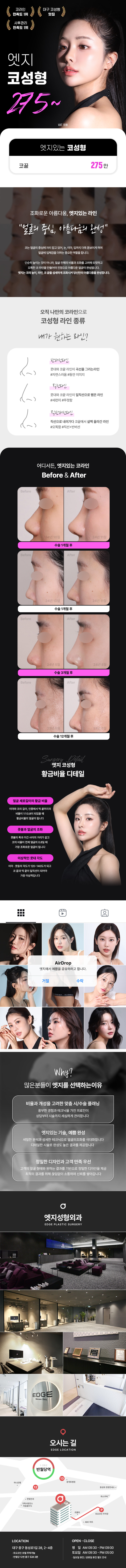 엣지성형외과 대구 엣지 시그니처 코성형 이벤트, 시술 상세 이미지