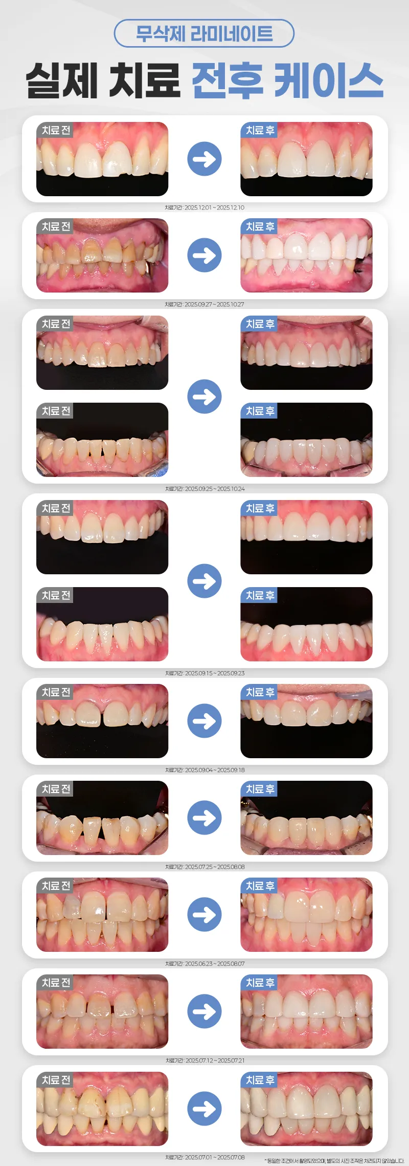 연세다감치과 치아손상 없는 무삭제 라미네이트 이벤트, 시술 상세 이미지