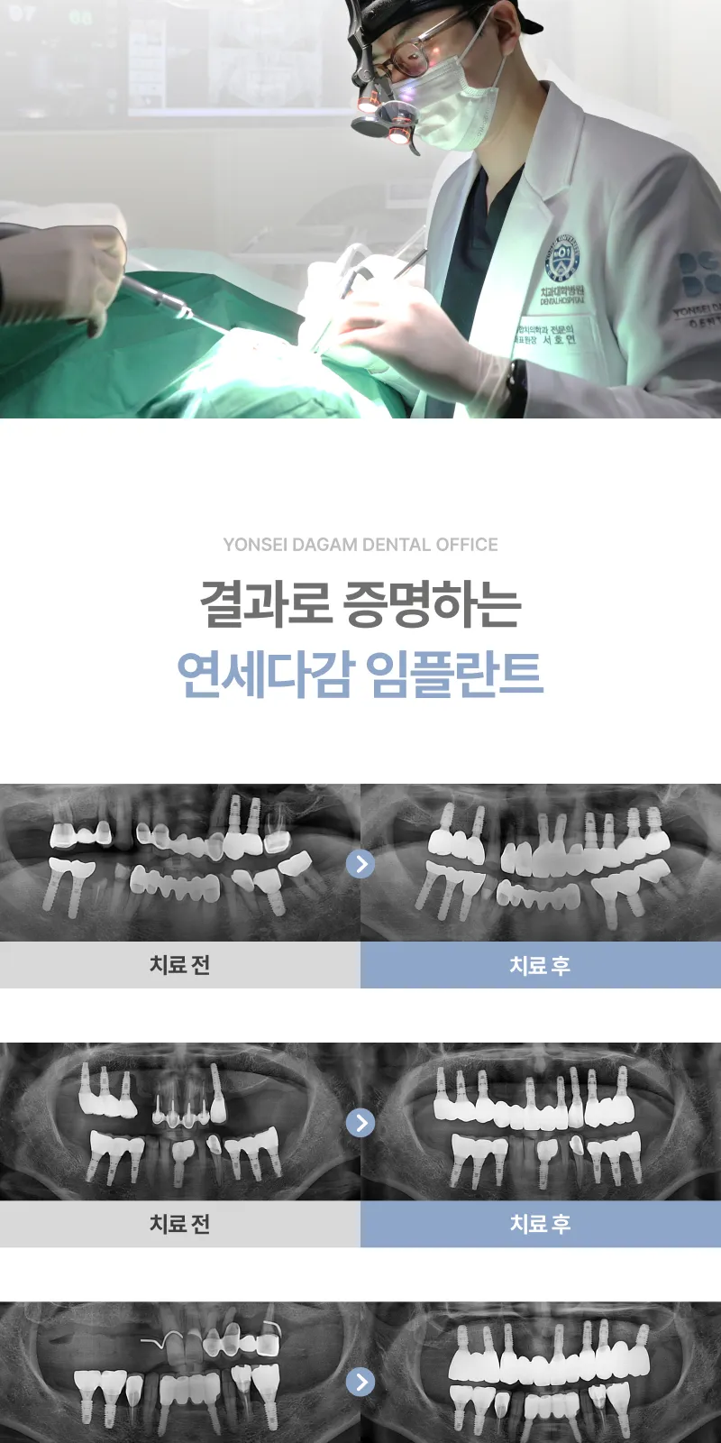 무절개 임플란트, 오스템 SOI