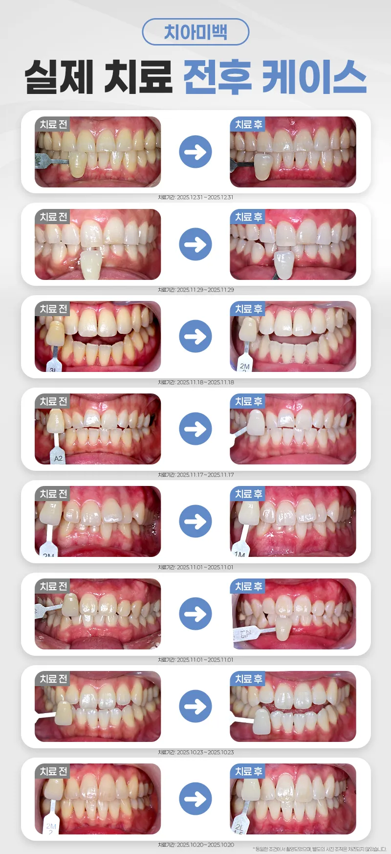 연세다감치과 다시 하얗게, 치아 미백 /당일 2회 이벤트, 시술 상세 이미지