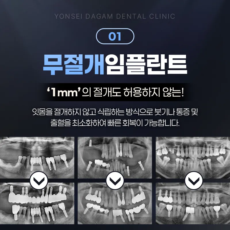 연세다감치과 빠른 일상복귀, 무절개 임플란트 이벤트, 시술 상세 이미지