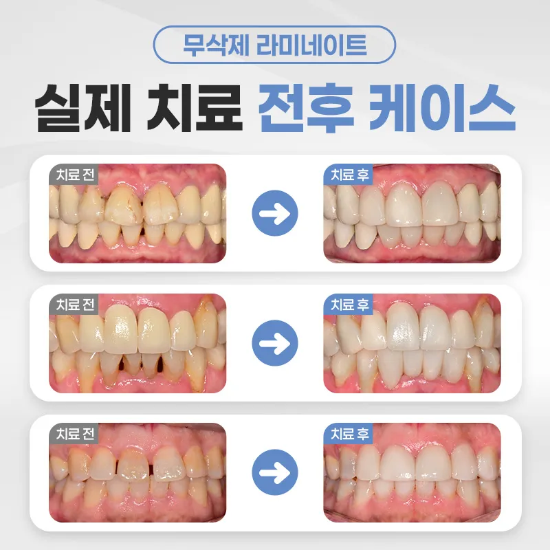 연세다감치과 치아손상 없는 무삭제 라미네이트 이벤트, 시술 상세 이미지