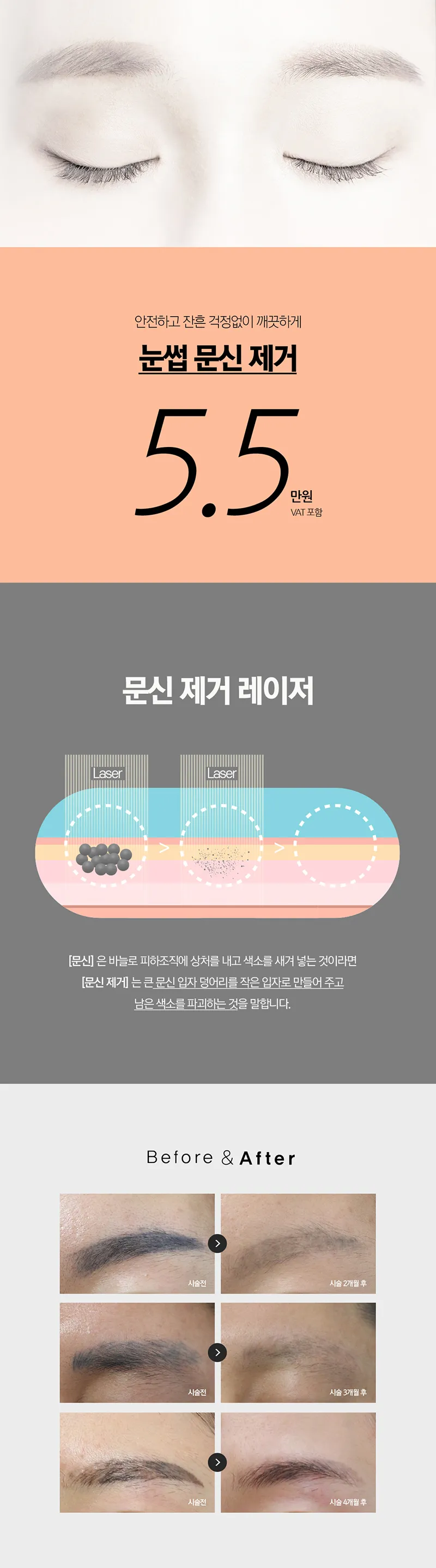 오크우드봄의원 클린 눈썹 문신 제거 이벤트, 시술 상세 이미지