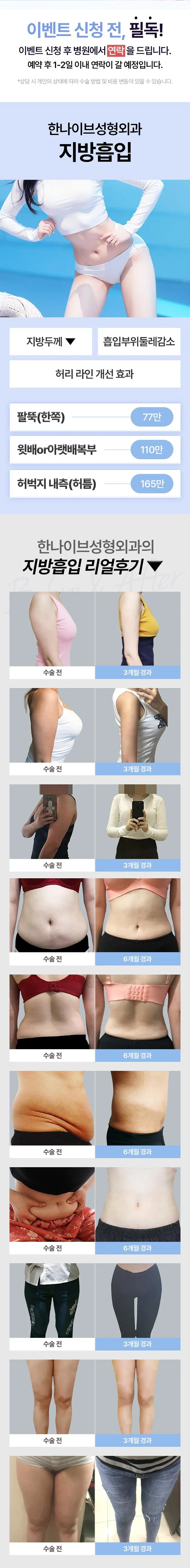 한나이브성형외과의원 대용량 핸드메이드 바디 지방흡입 이벤트, 시술 상세 이미지