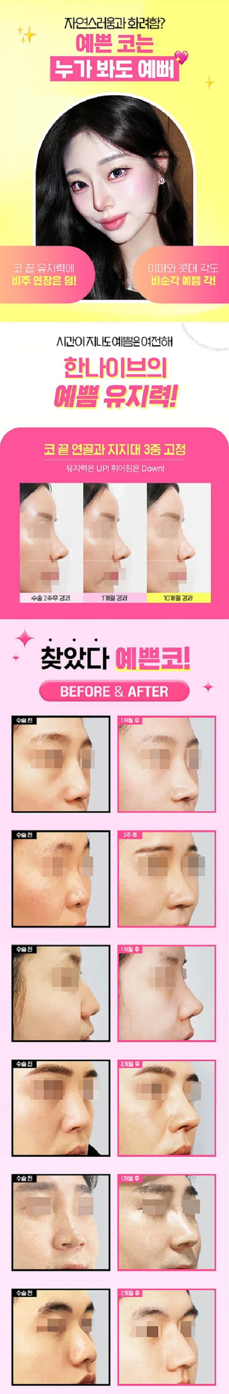 한나이브성형외과의원 자려한 콧대코끝 커스텀성형 이벤트, 시술 상세 이미지