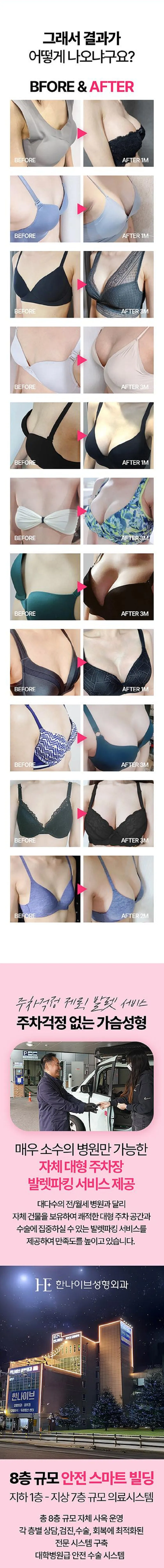 한나이브성형외과의원 한나이브 리얼감탄 가슴성형 가슴확대 이벤트, 시술 상세 이미지
