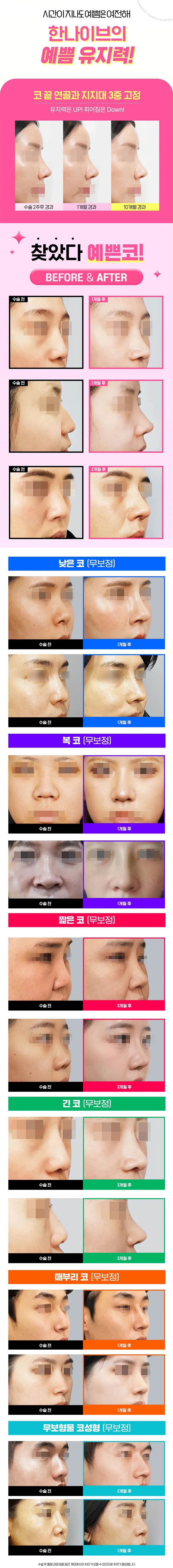 자려한 콧대코끝 커스텀성형