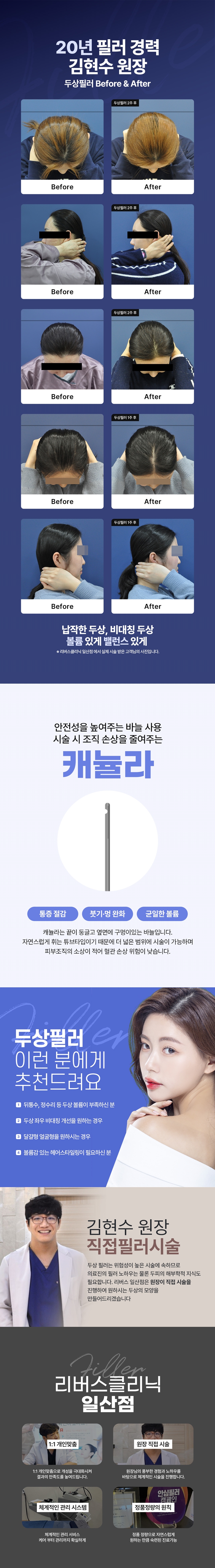 리버스클리닉 일산 일산 두상필러 밋밋한 두상에 볼륨을 이벤트, 시술 상세 이미지