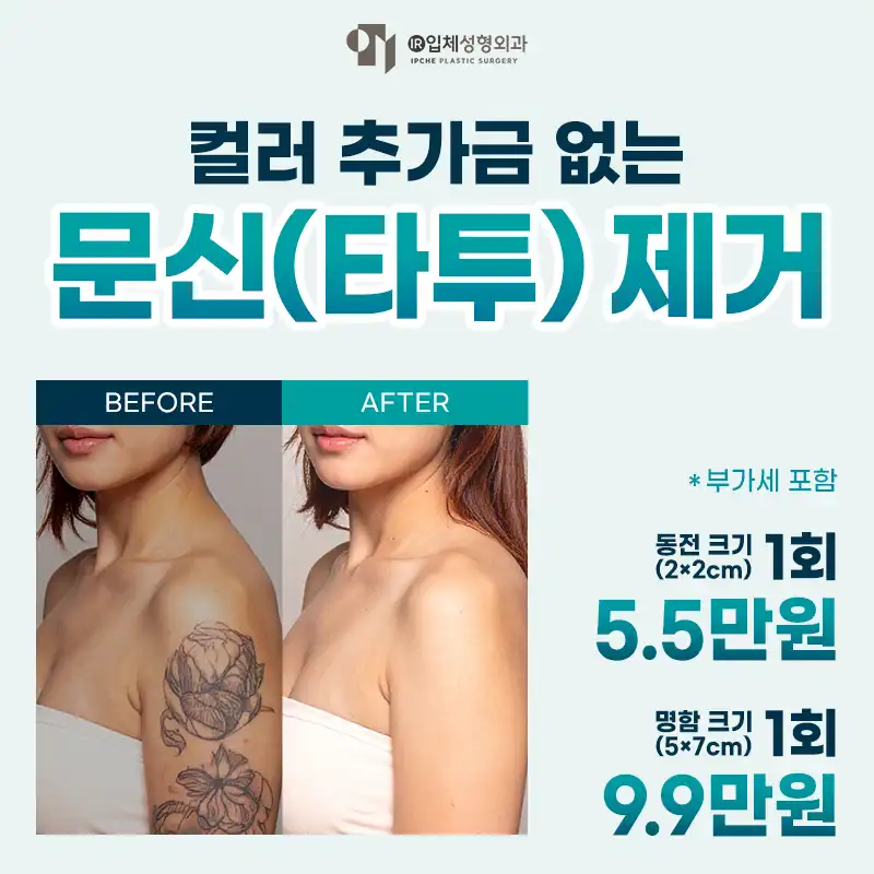 추가금 없는 문신(타투)제거