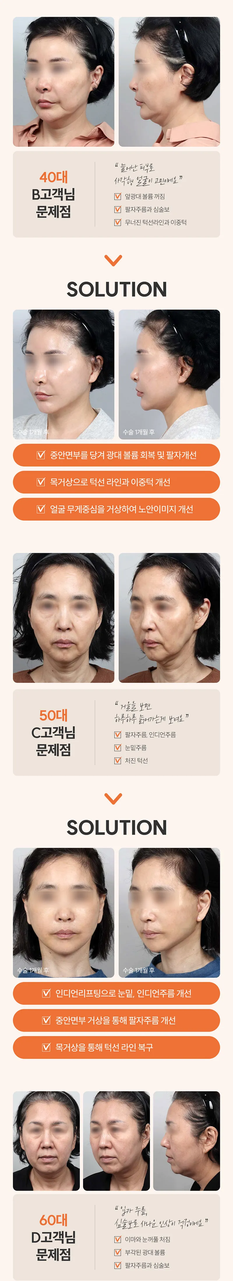 입체성형외과의원 입체 SMAS 안면거상 이벤트, 시술 상세 이미지