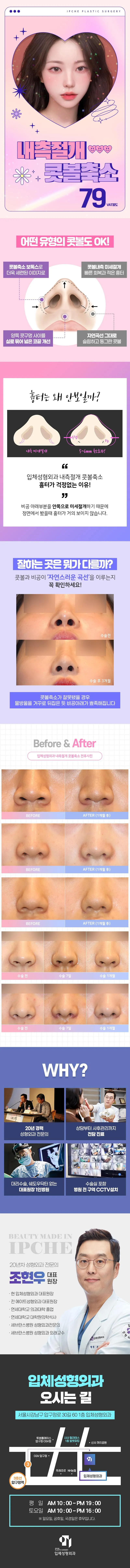 입체성형외과의원 내측 미세절개 콧볼축소 이벤트, 시술 상세 이미지