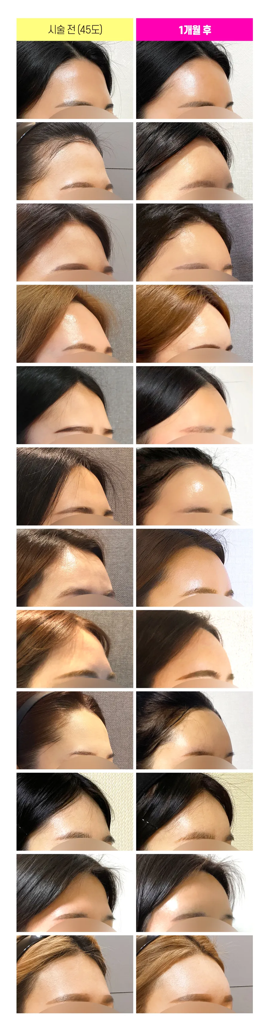 釜山I.M.丰盈额头填充剂美丽地提升轮廓