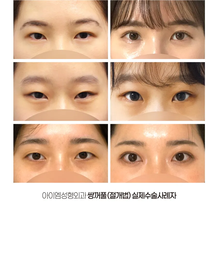 釜山好看的眼睛我是双眼皮切开法