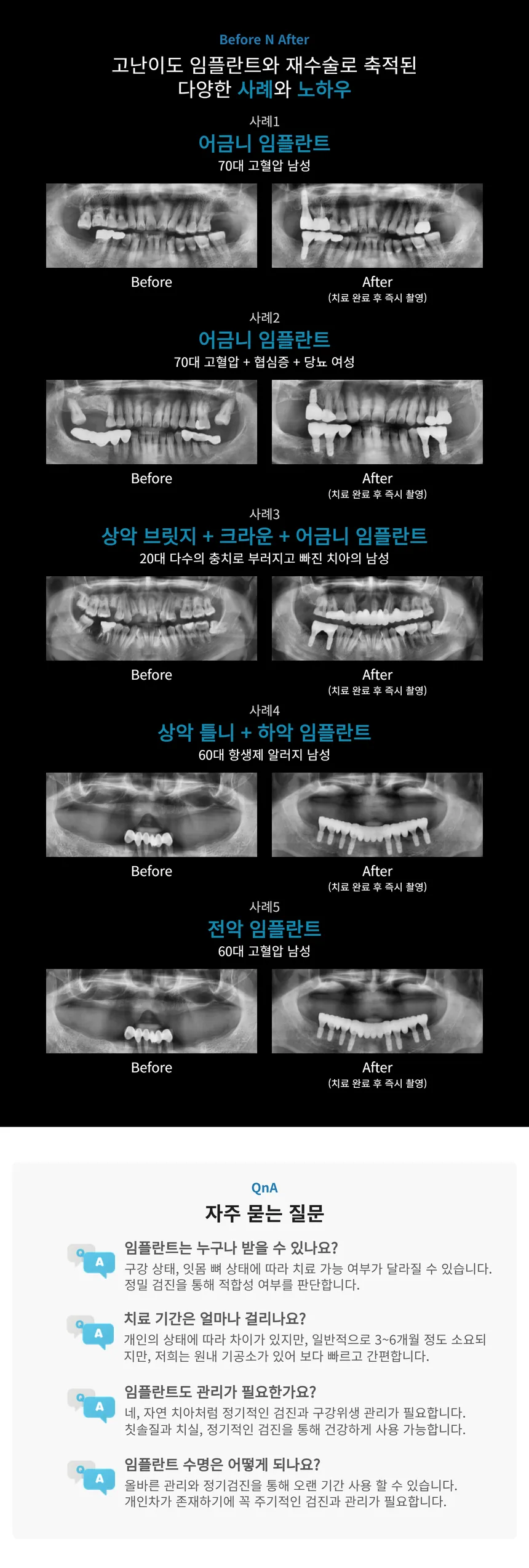 국산 정품 오스템 임플란트 39만원💙