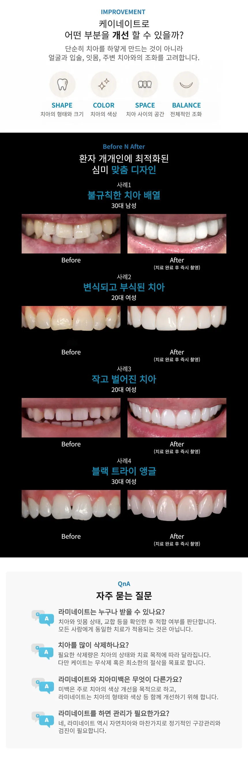 [원내 기공소 보유] 무삭제 케이 라미네이트💙