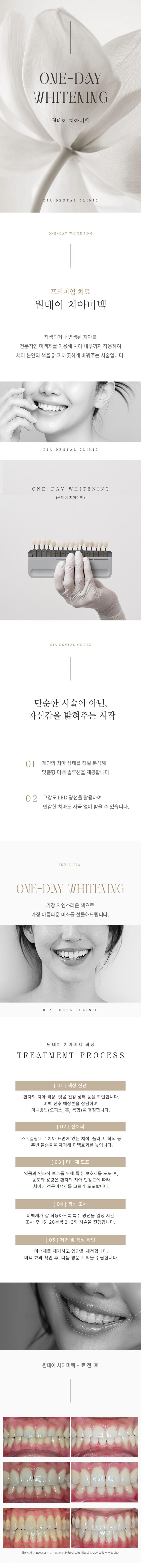 서울디아치과의원 원데이 치아미백 3회 이벤트, 시술 상세 이미지