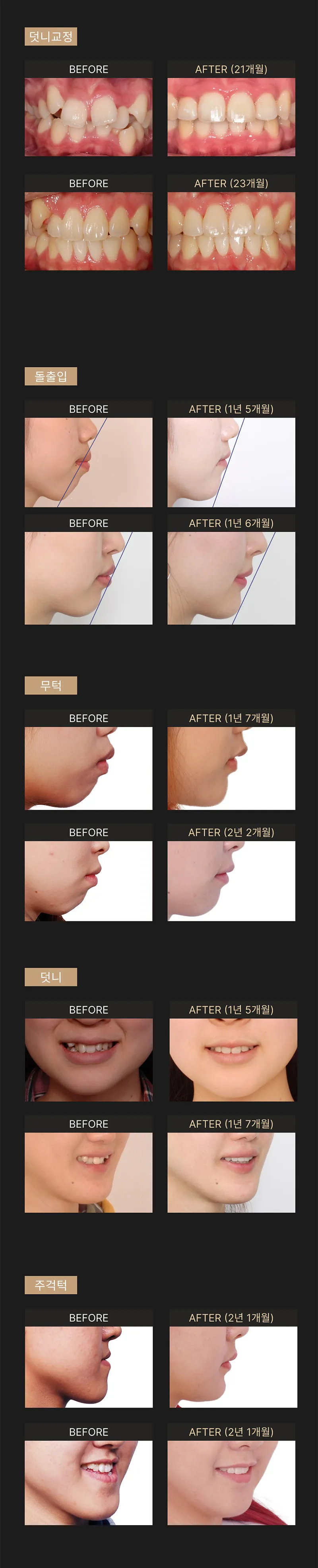 세라믹치과의원 ★수술없이 얼굴라인+치아교정=월15★ 이벤트, 시술 상세 이미지