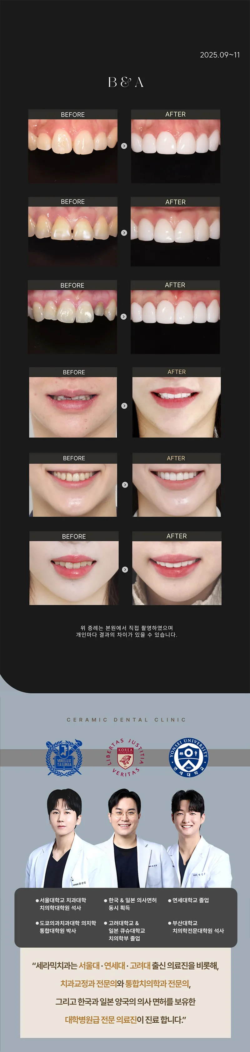 세라믹치과의원 추가비용 없는 무삭제 세라네이트 이벤트, 시술 상세 이미지
