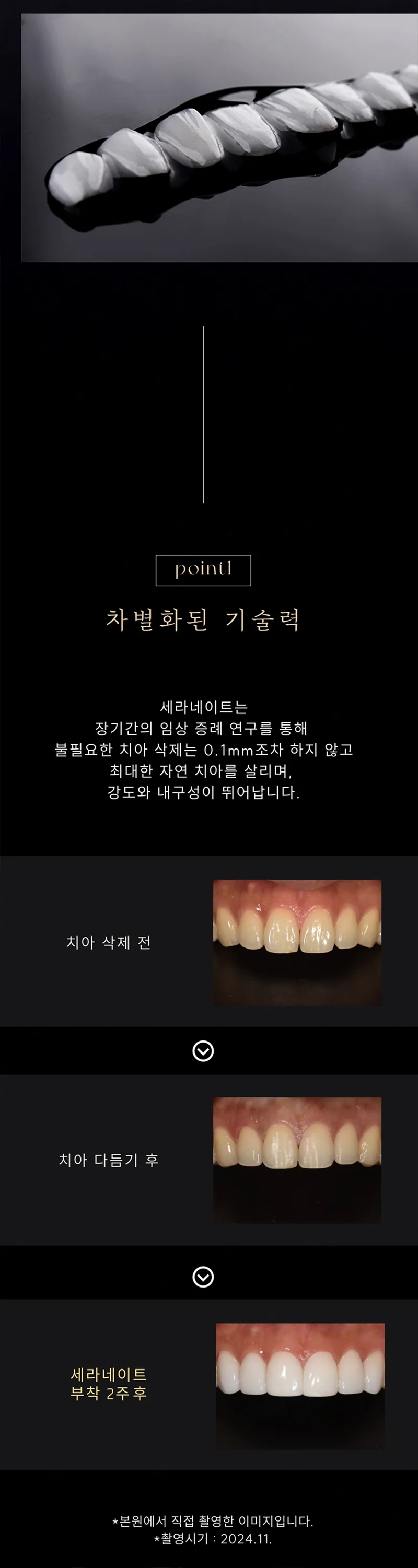세라믹치과의원 추가비용 없는 무삭제 세라네이트 이벤트, 시술 상세 이미지