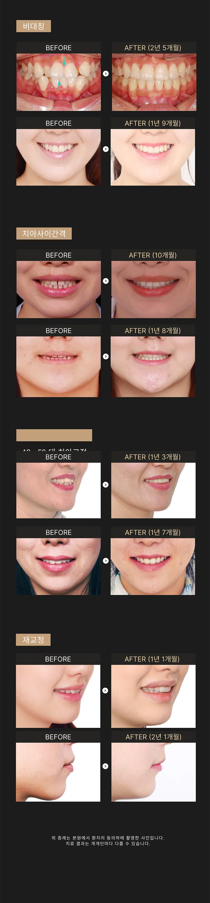 세라믹치과의원 ★수술없이 얼굴라인+치아교정=월15★ 이벤트, 시술 상세 이미지