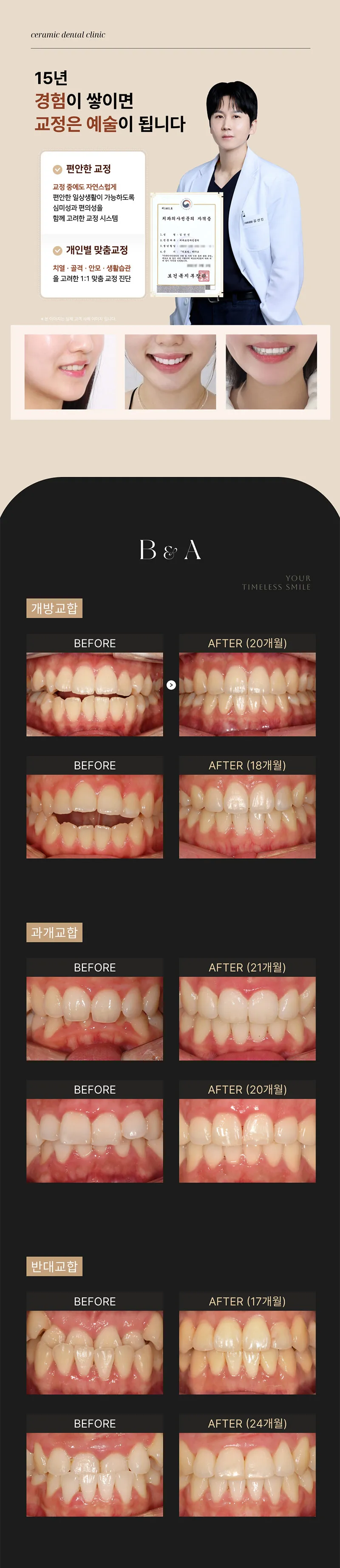 세라믹치과의원 ★수술없이 얼굴라인+치아교정=월15★ 이벤트, 시술 상세 이미지