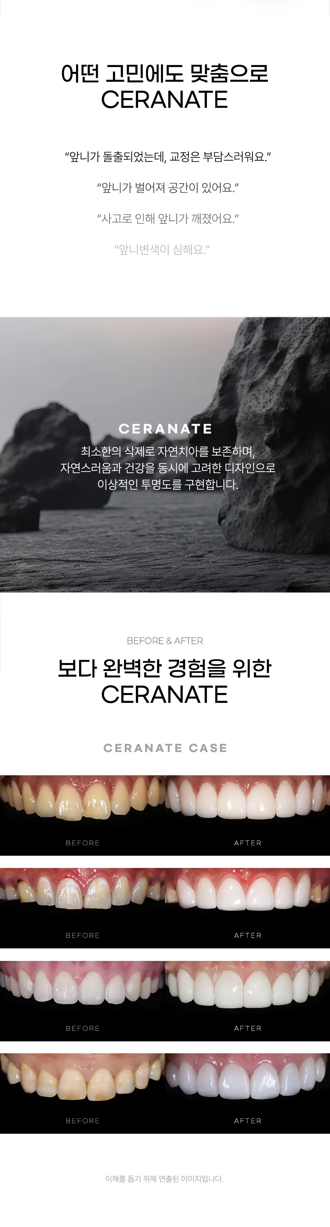 세라믹치과의원 추가비용 없는 무삭제 세라네이트 이벤트, 시술 상세 이미지