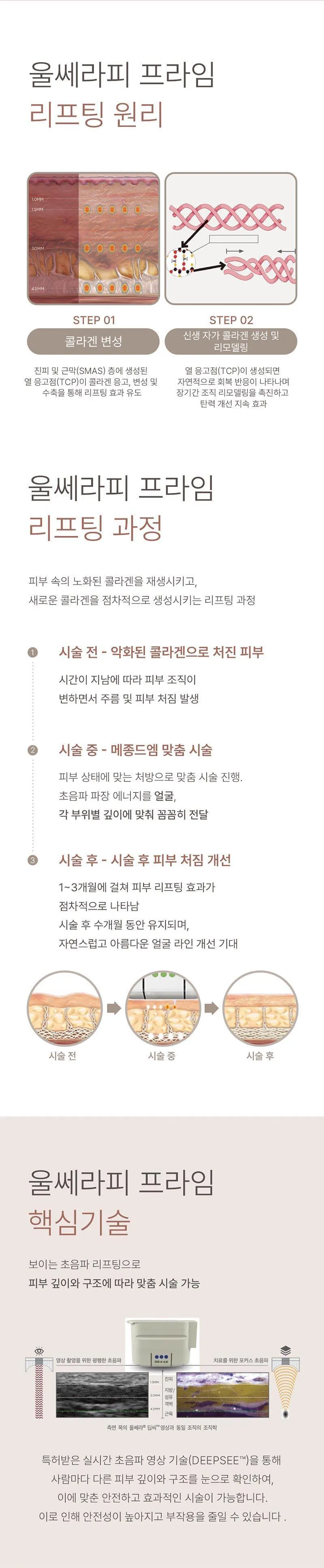 메종드엠의원 울쎄라피 프라임 이벤트, 시술 상세 이미지