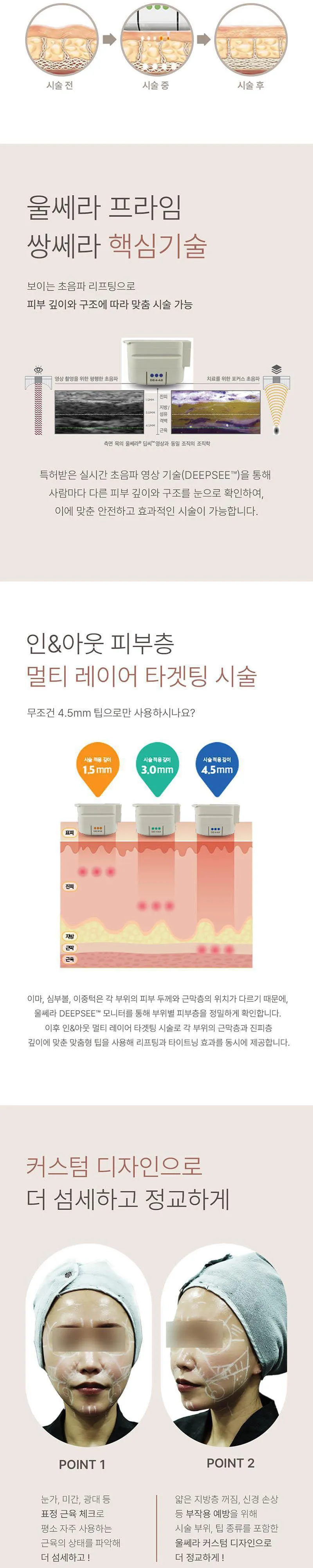 메종드엠의원 울쎄라피 프라임 쌍쎄라 이벤트, 시술 상세 이미지