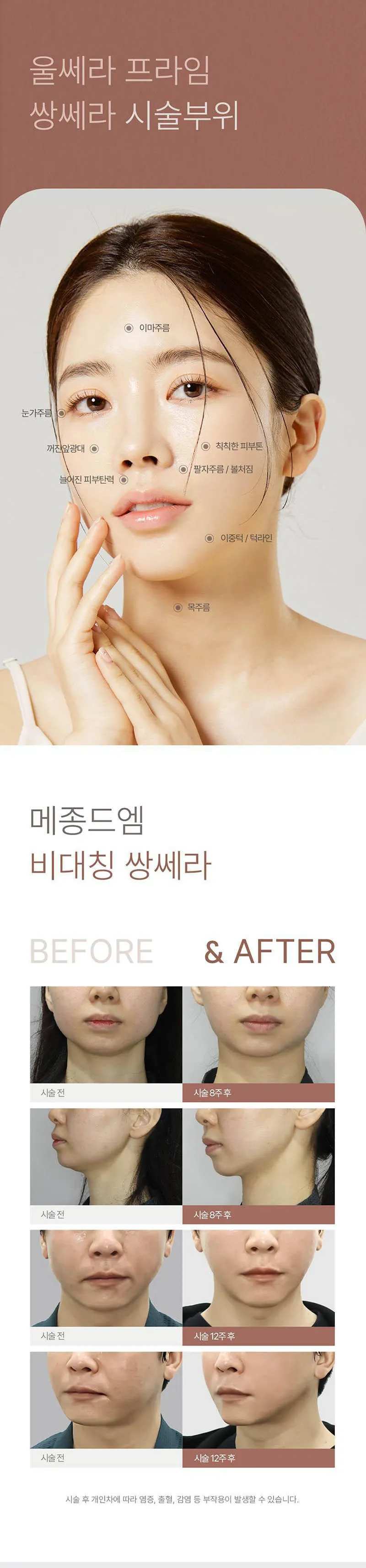 메종드엠의원 울쎄라피 프라임 쌍쎄라 이벤트, 시술 상세 이미지