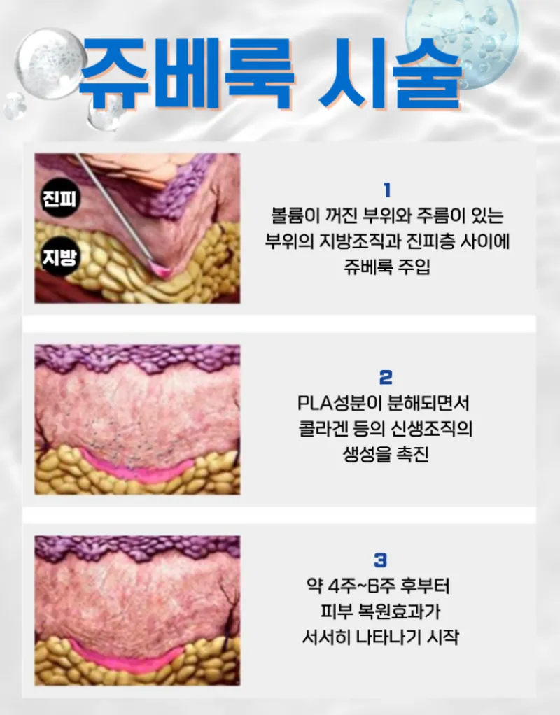 올림피움채움 올피채의원 강남점 올피채 쥬베룩,쥬베룩볼륨,쥬베룩 아이 이벤트, 시술 상세 이미지