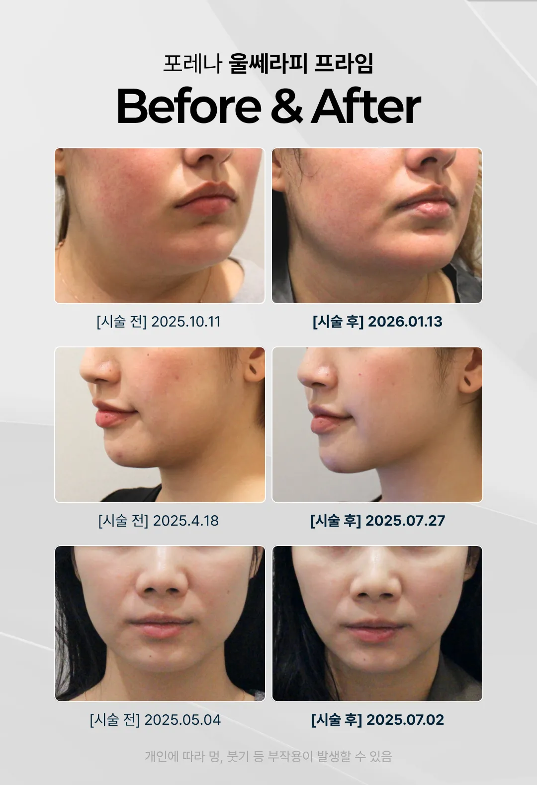 포레나의원 홍대입구역 울쎄라피 프라임 이벤트, 시술 상세 이미지
