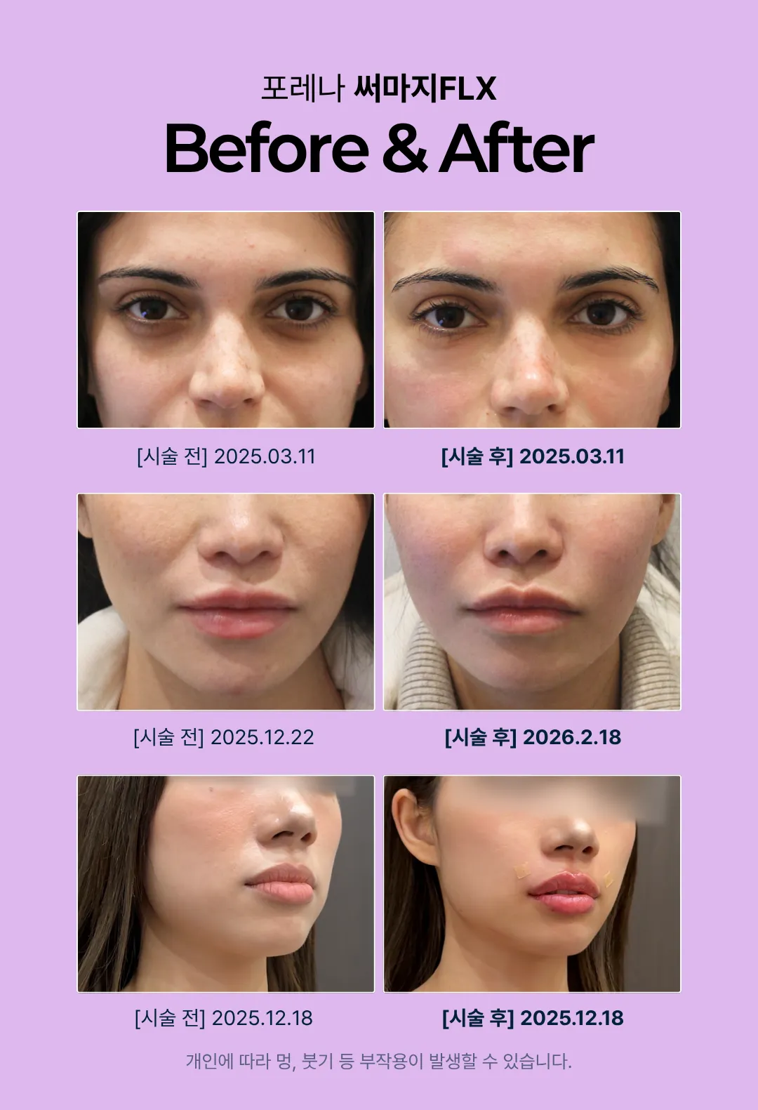 포레나의원 [홍대 포레나의원] 정품팁 맞춤 써마지 FLX 이벤트, 시술 상세 이미지