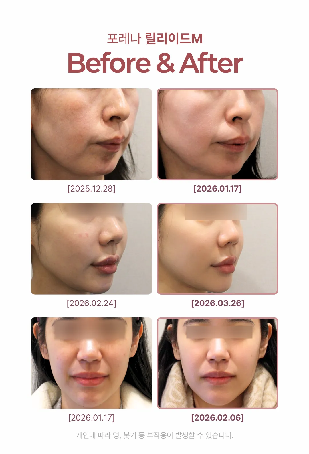 포레나의원 [홍대 포레나의원] 릴리이드M 물광 주사 5cc 이벤트, 시술 상세 이미지