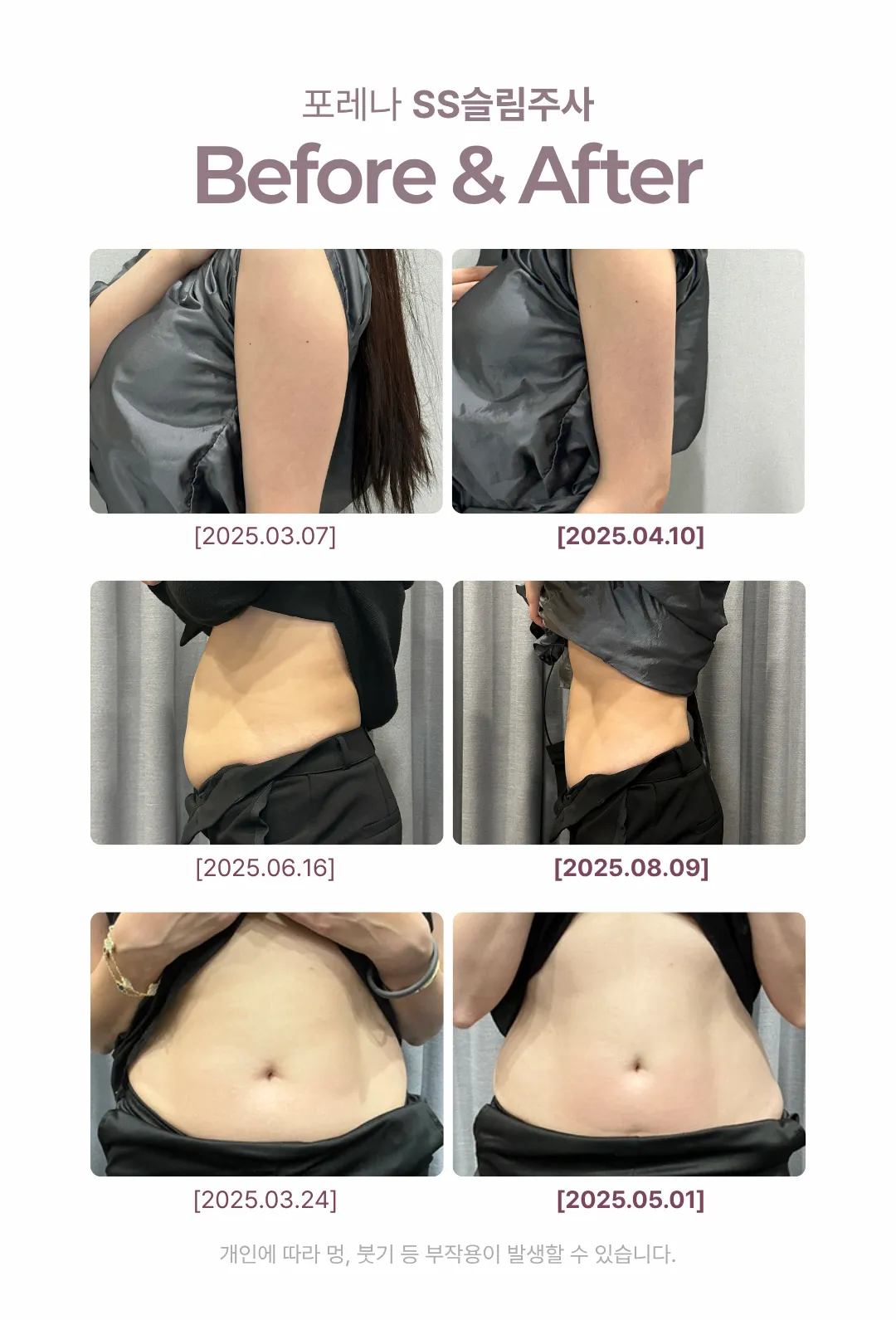 포레나의원 홍대 대용량 SS슬림주사 지방분해주사_스테로이드 미포함 이벤트, 시술 상세 이미지