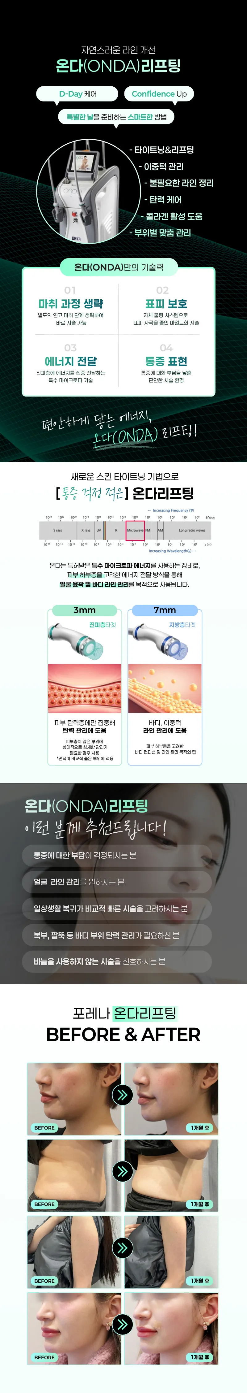 포레나의원 온다 리프팅 이벤트, 시술 상세 이미지