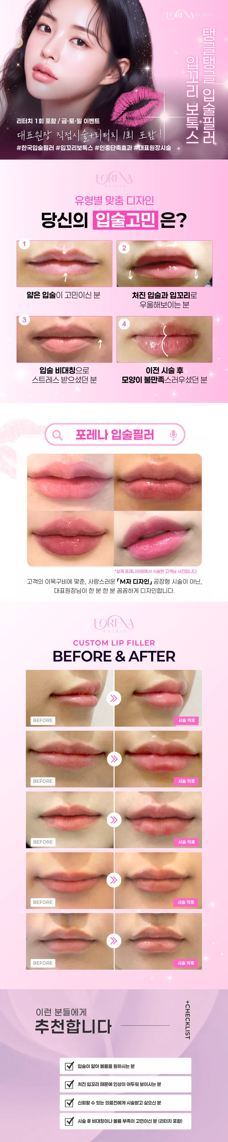 포레나의원 입술필러+입꼬리 보톡스 이벤트, 시술 상세 이미지