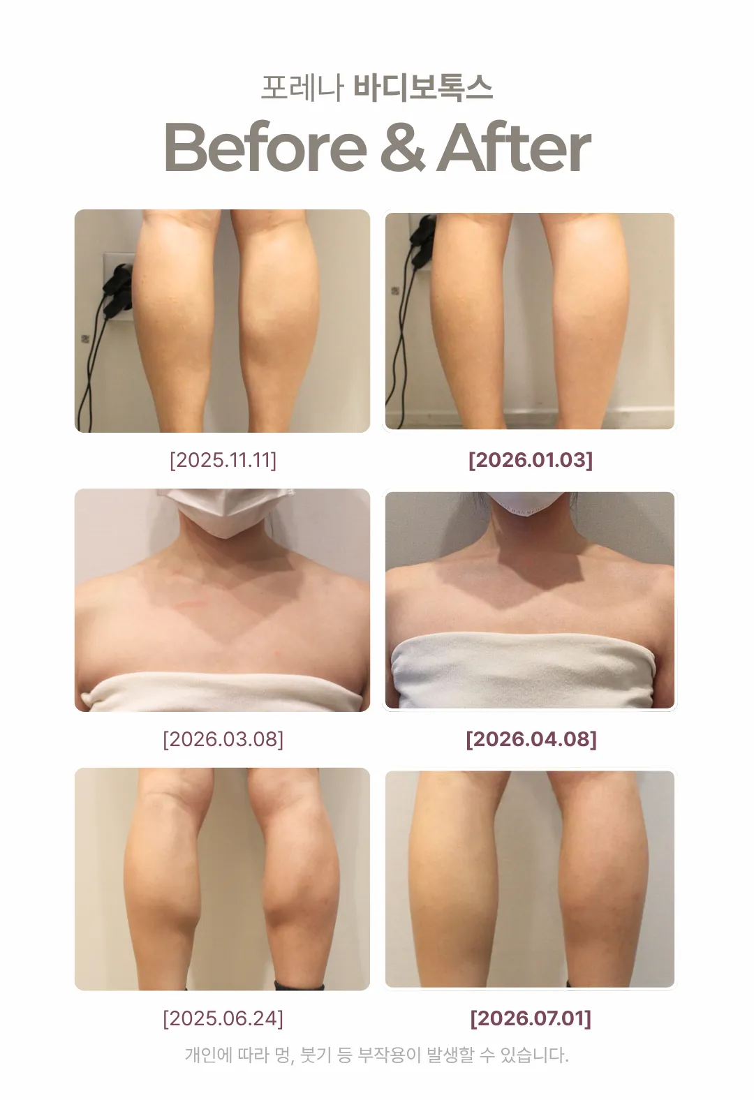 포레나의원 홍대 바디보톡스 국내/수입 보톡스 이벤트, 시술 상세 이미지