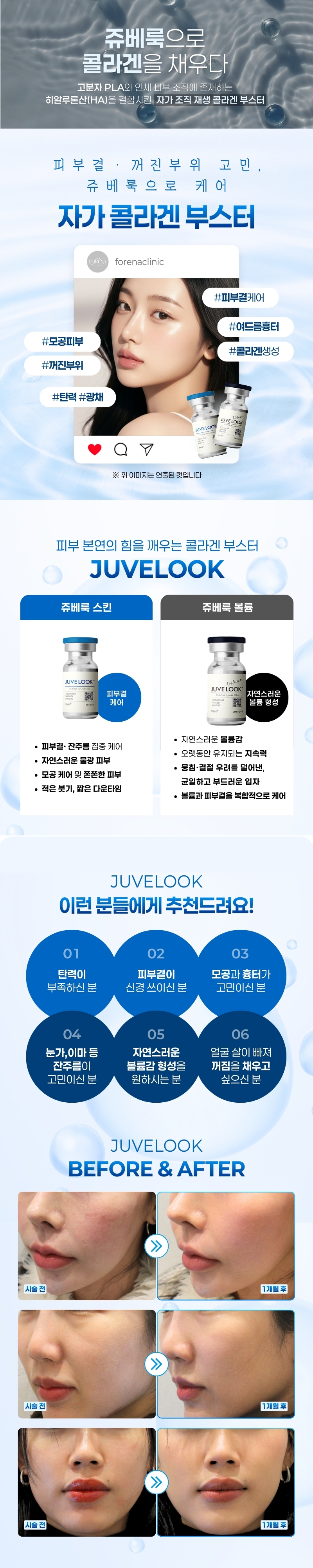 포레나의원 쥬베룩 스킨/볼륨 이벤트, 시술 상세 이미지