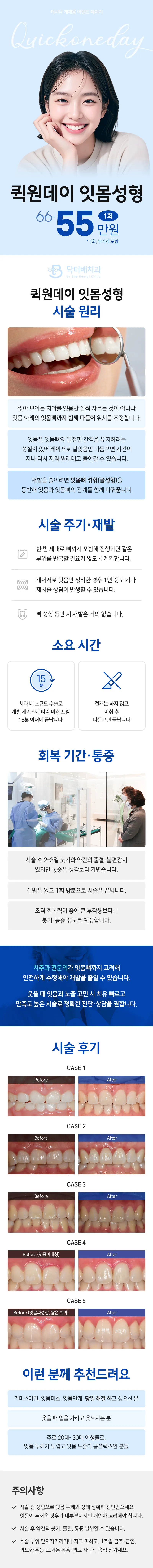 닥터배치과의원 퀵원데이 잇몸성형 이벤트, 시술 상세 이미지