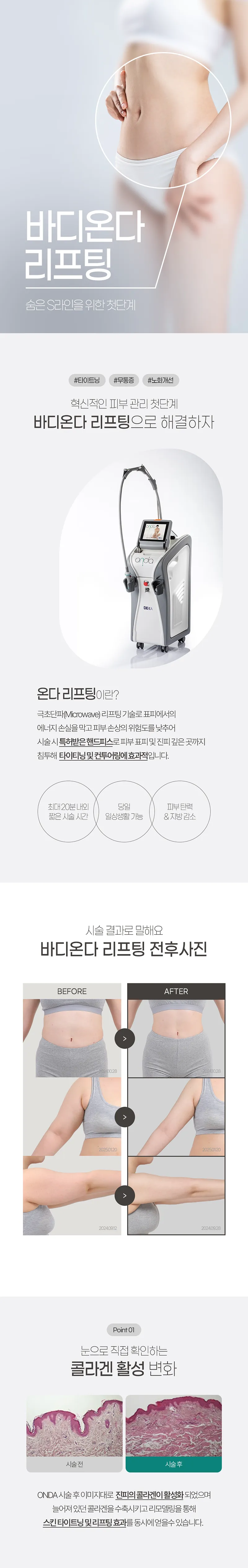 브이에스라인의원-인천구월점 바디 온다리프팅 200KJ 3회 이벤트, 시술 상세 이미지