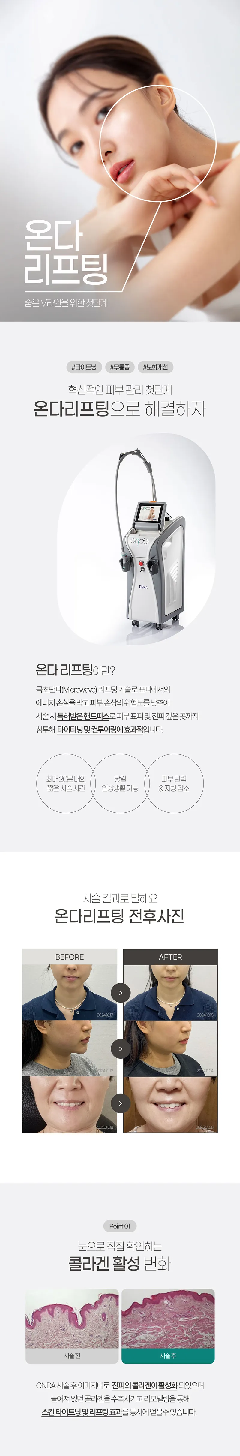 브이에스라인의원-일산점 온다리프팅  40KJ 이벤트, 시술 상세 이미지
