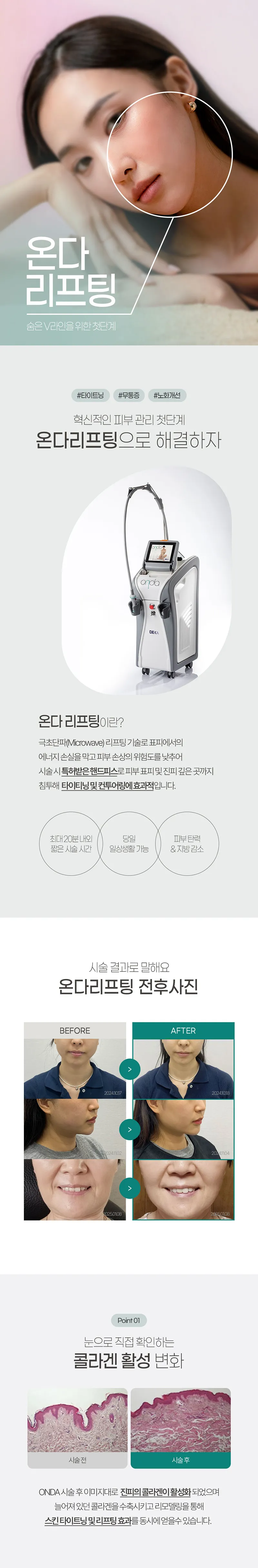 엔디어트의원 온다리프팅 60KJ 이벤트, 시술 상세 이미지