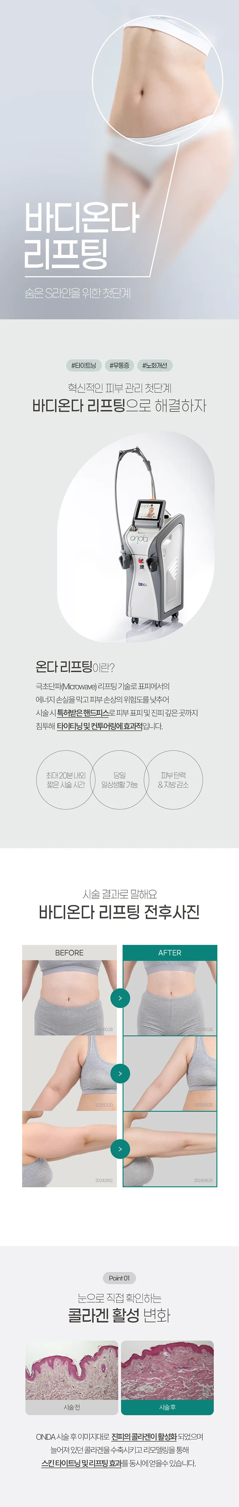 엔디어트의원 바디 온다리프팅 80KJ 이벤트, 시술 상세 이미지