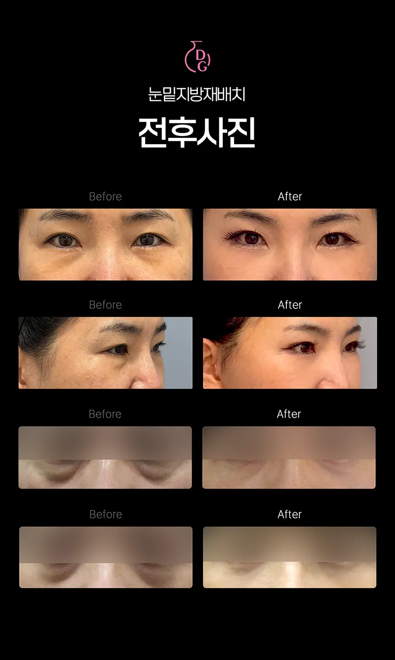 도자기의원 진짜 특가! 눈밑지방재배치 이벤트, 시술 상세 이미지