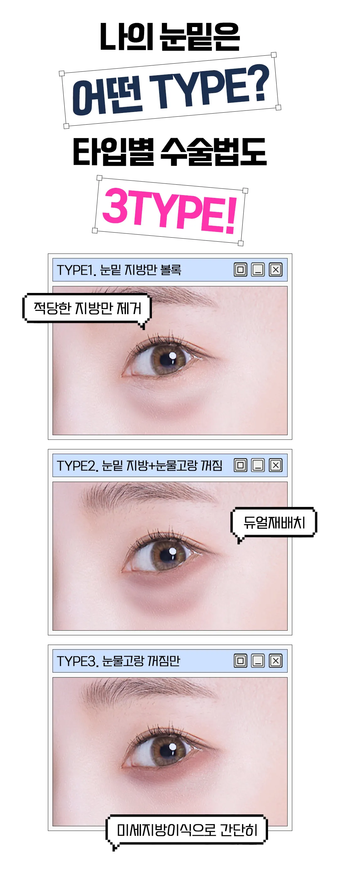 세이예스의원  다크서클, 눈밑지방에 효과 좋은 눈밑지방재배치 이벤트 이벤트, 시술 상세 이미지