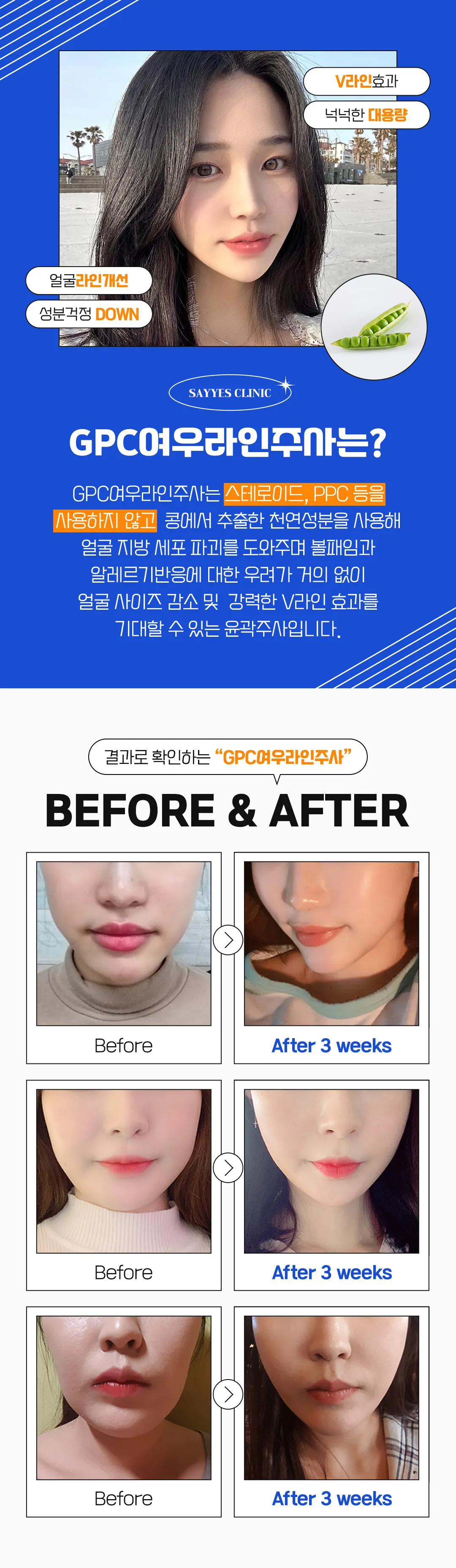 세이예스의원 스테로이드 놉! 대용량 윤곽주사 12CC 이벤트 이벤트, 시술 상세 이미지