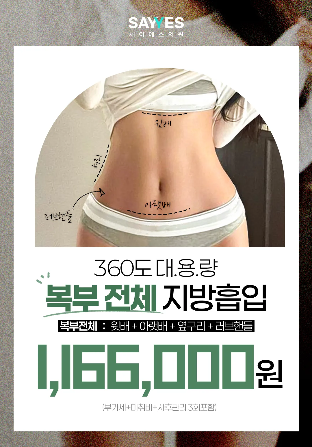 세이예스의원 대용량 복부전체지방흡입, 앞복부+옆구리+러브핸들 흡입 이벤트, 시술 상세 이미지