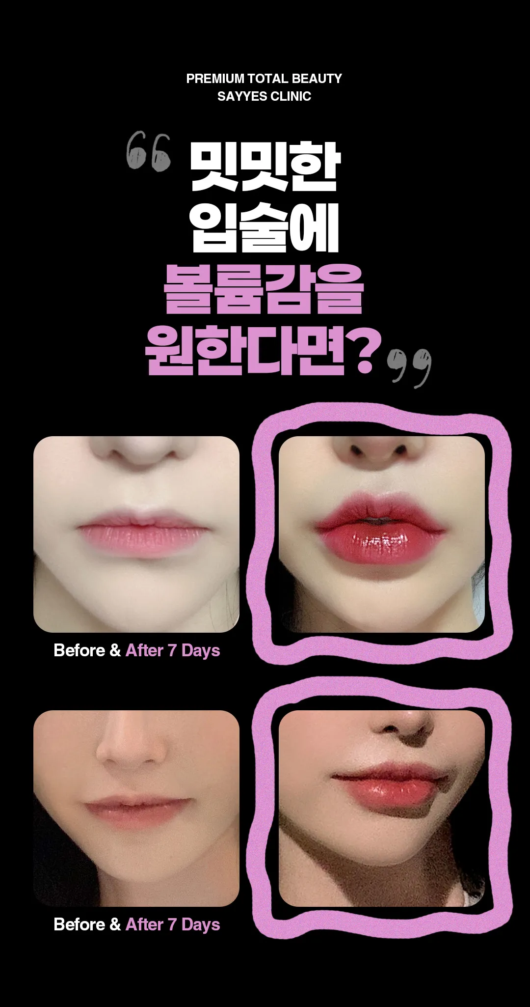 세이예스의원 입술패키지 이벤트_입꼬리필러,입꼬리보톡스,입술필러까지! 이벤트, 시술 상세 이미지