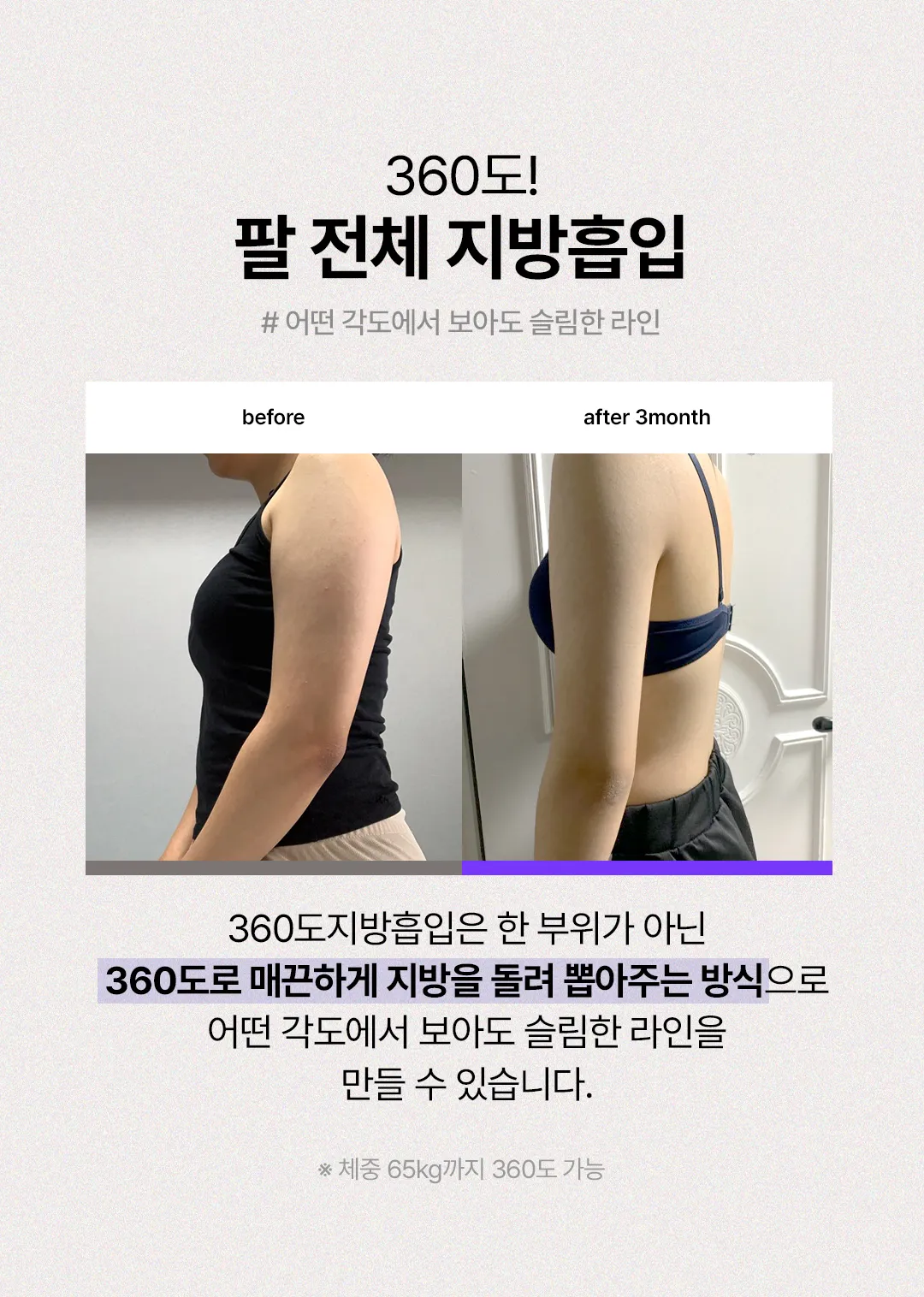 세이예스의원 대용량 팔전체지방흡입 여리여리한 일자 팔뚝완성 이벤트, 시술 상세 이미지